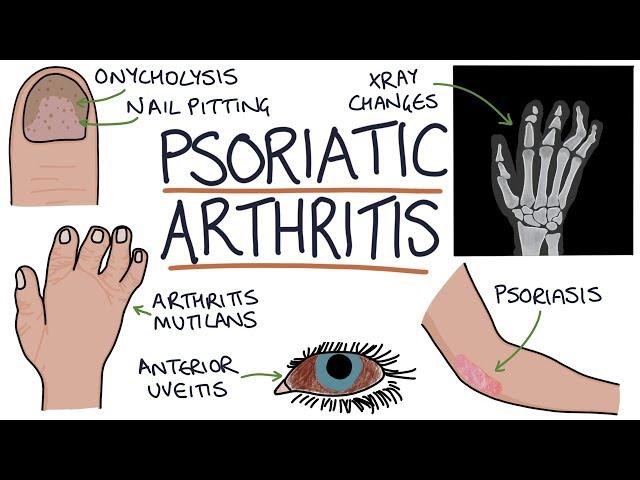 Psoriatic Arthritis