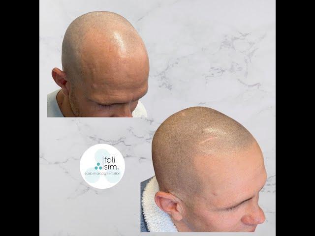 Scalp Micropigmentation Transformed My Hairline... - Robert's SMP Experience with Foli Sim