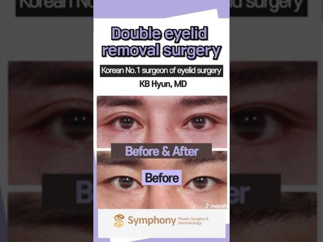 Lowering double eyelid crease (Asian monolids) cosmetic surgery before and after at Symphony