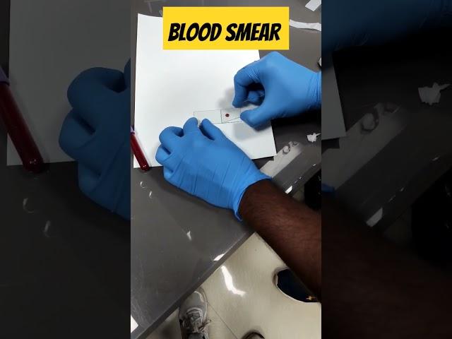 Prepare a perfect blood Smear 🩸#medical #viralvideo  #youtube #pathology #ytshort #ytviral#yt #lab