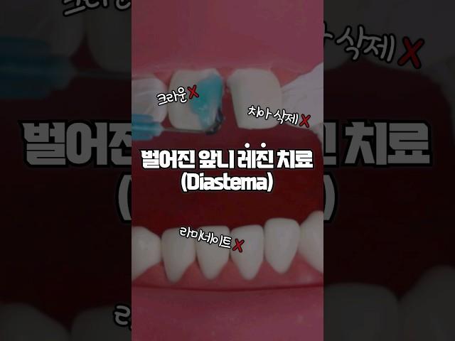 치아 삭제없이 벌어진 앞니를 치료하는 법.