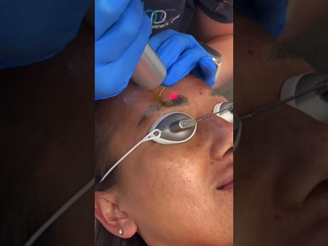 How satisfying is this! #tattooremoval #lasertattooremoval #pigmentation #tattooremover #laser