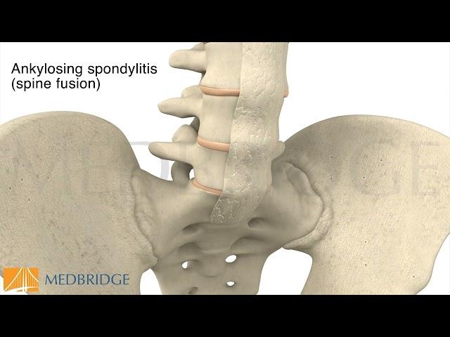 Ankylosing Spondylitis | MedBridge