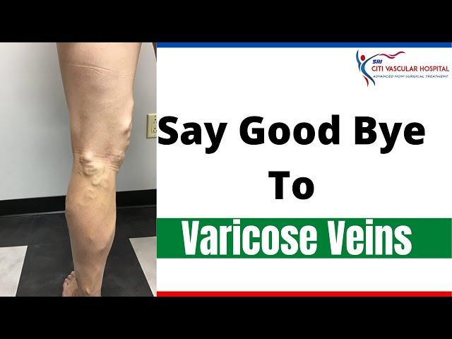 Varicose veins | Treating Varicose veins without surgery in hyderabad