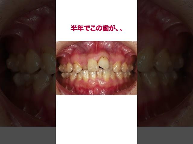 ワイヤーではなくマウスピース矯正で治したい方必見#shorts #歯列矯正 #マウスピース矯正#インビザライン