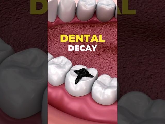 New Compound May Prevent #Dental Decay