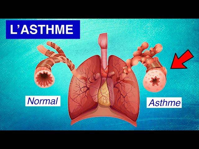 Asthme bronchique : Physiopathologie, Symptômes et Traitements