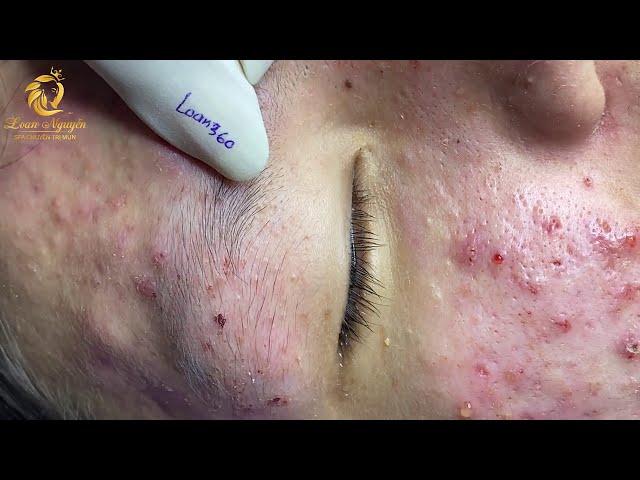 Treatment of acne tablets, pustules and blackheads (360) | Loan Nguyen