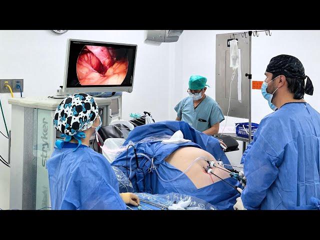 Dr. Miguel Montalvo Performing Gastric Sleeve with Hernia Repair