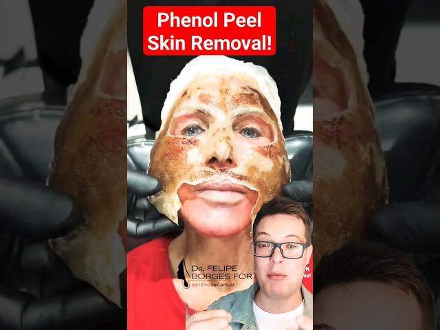 (TW) SHOCKING PHENOL PEEL Skin Removal #shorts