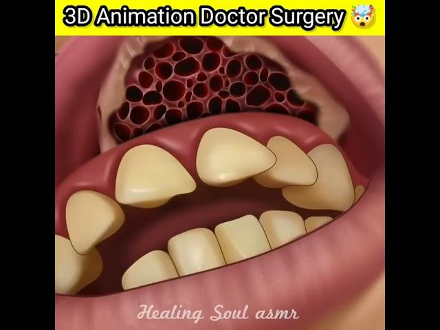 3D Animation Doctor infection surgery  ? #shorts #viral