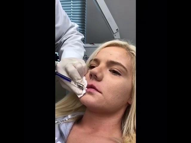 Permanent Lip Augmentation with Silikon-1000