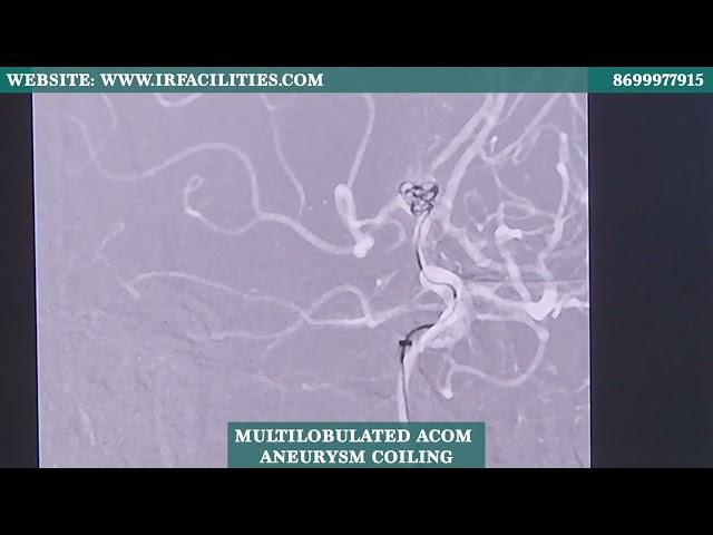 Multilobulated ACOM Aneurysm Coiling Performed Live by Dr. Sandeep Sharma | IRFACILITIES