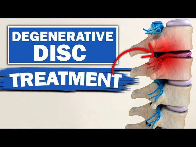 Degenerative Disc Disease Treatment & 2 Best Exercises