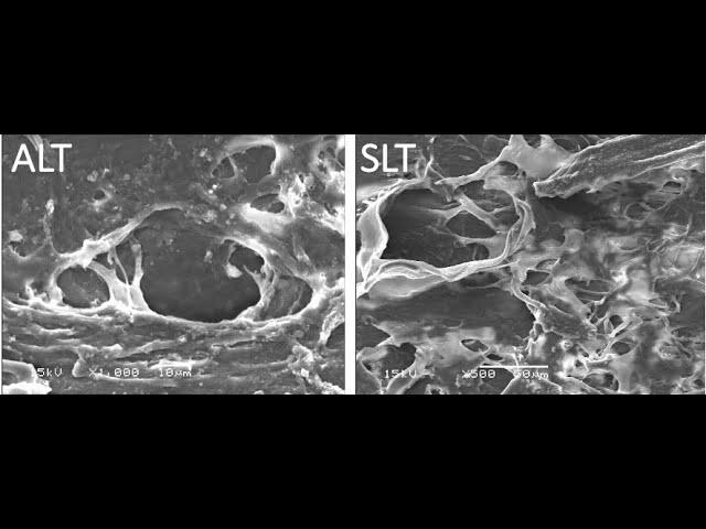 Selective Laser Trabeculoplasty: Tips and Tricks (Malik Y. Kahook, MD)