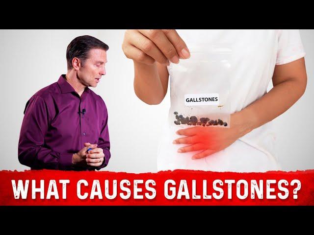 Does a High Fat Diet Causes Gallstones? – Dr. Berg