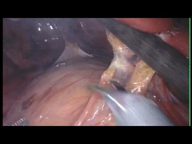 Mohling Diaphragm Endometriosis Excision