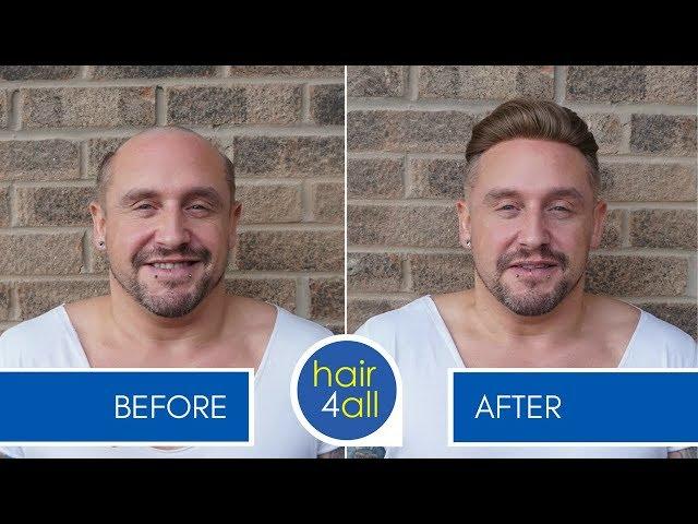 Before & After a Non-Surgical Hair Replacement System for Men (Hair Loss/Baldness)