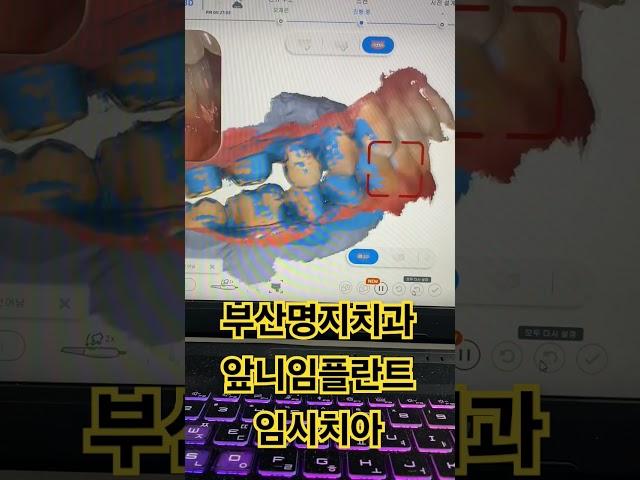 부산명지치과 앞니임플란트 임시치아