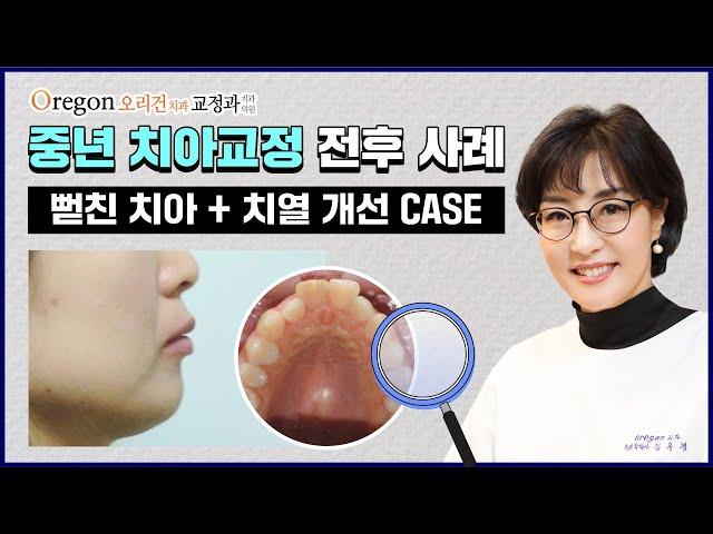 아랫니 발치 후 뻗친 치아와 치열 개선한 중년치아교정 CASE를 소개합니다!【Feat. 교정전문의 김옥경원장님】