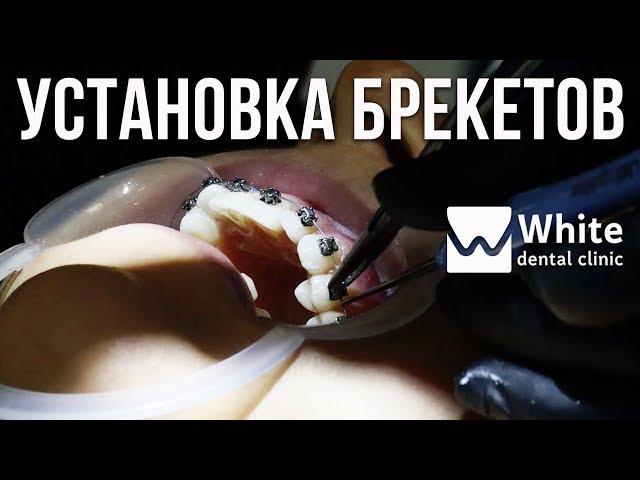 Установка брекетов - выравнивание зубов в Самаре