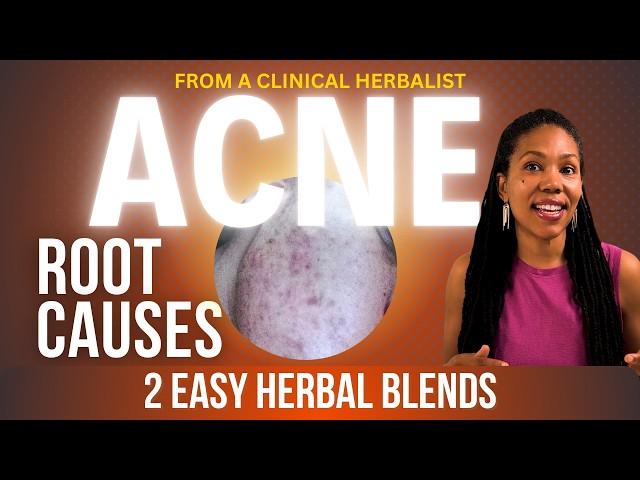 Heal Acne Naturally: What You Haven’t Been Told | Clinical Herbalist