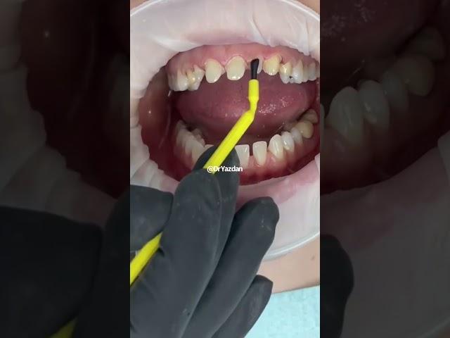 Porcelain crowns front teeth | smile makeover before and after | Dr. Yazdan | smile makeover veneers