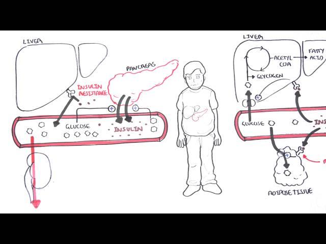 Diabetes Type II Pathophysiology