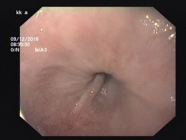 Endoscopija divertikuluma jednjaka