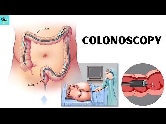 What You Need to Know Before Scheduling a Colonoscopy?