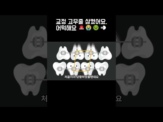 교정 고무줄 삼켰어요. 어떡해요 ㅠㅠ  #교정중생기는