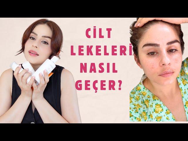 YAZIN LEKE Bakımı | Cilt lekeleri için kullanılması gereken içerikler & Örnek Rutin