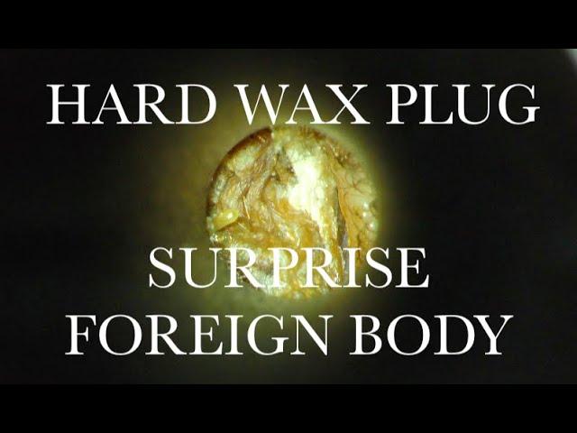 EAR WAX REMOVAL : SURPRISE FOREIGN BODY : 4K/HD