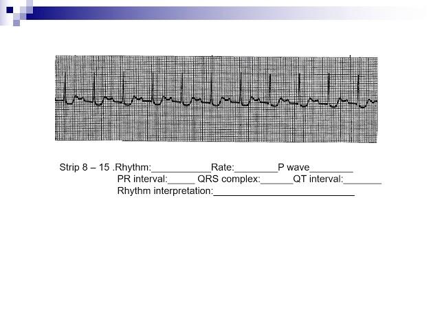 AV blocks, ventricular, and pacemaker homework review video