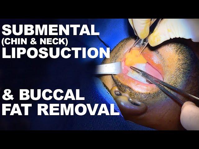 Submental (Chin & Neck) Liposuction and Buccal Fat Removal- Dr. Paul Ruff | West End Plastic Surgery