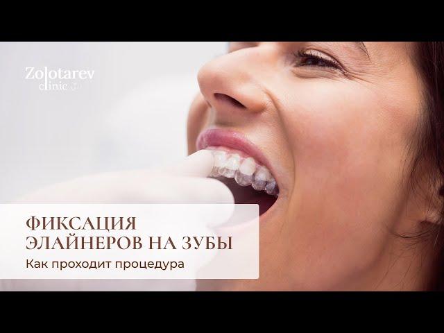 Фиксация элайнеров на зубы