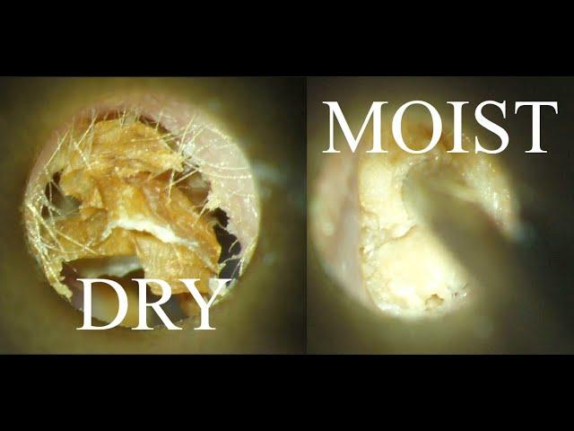 DRY vs MOIST Ear WAX Removal :  4K/HD