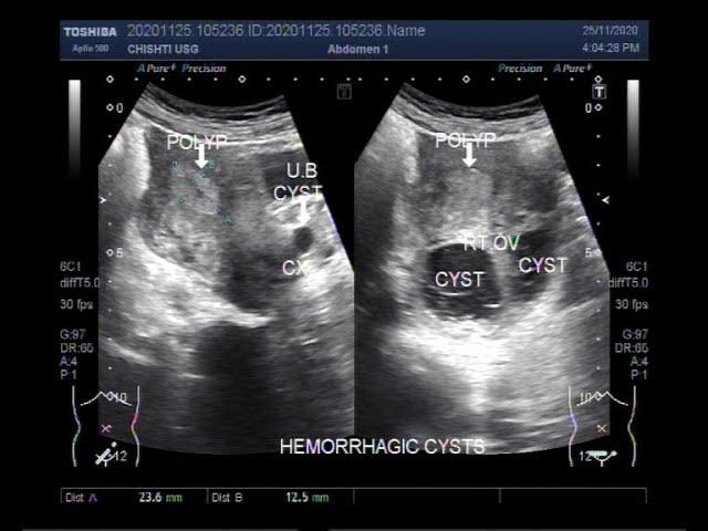 Ultrasound Video showing Uterine Polyp and two hemorrhagic Ovarian Cysts.