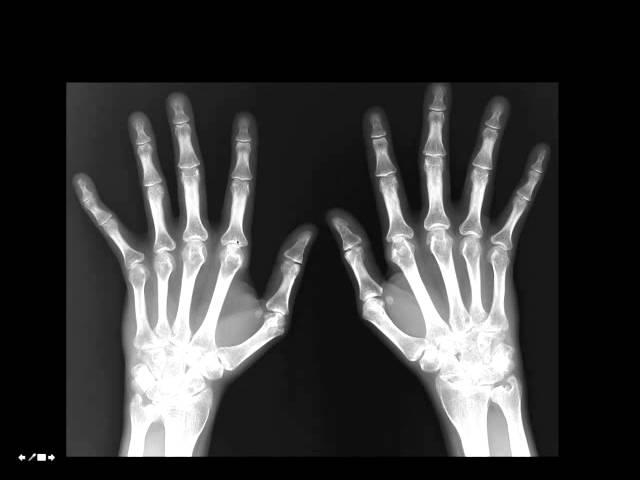 Radiographic Assessment of Arthritis