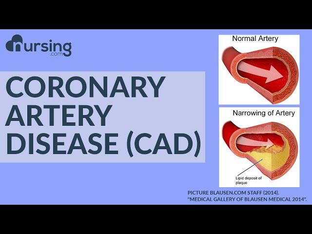 What is Coronary Artery Disease? And how do you treat it as a Nurse? (Nursing School Lesson)