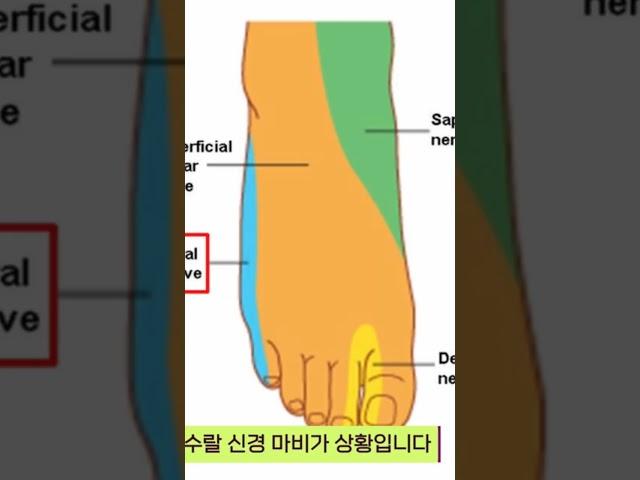 #무빙ems#재활#수술#마비#디스크#풋드롭#까치발#