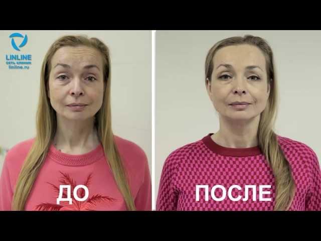 Как стать МОЛОЖЕ НА 5 ЛЕТ / Результат за НЕСКОЛЬКО ДНЕЙ / Процедура лазерного омоложения
