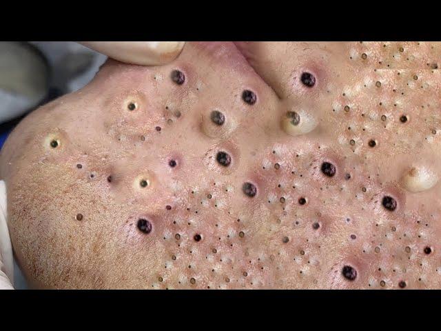 Big Cystic Acne Blackheads Extraction Blackheads & Milia, Whiteheads Removal Pimple Popping #009