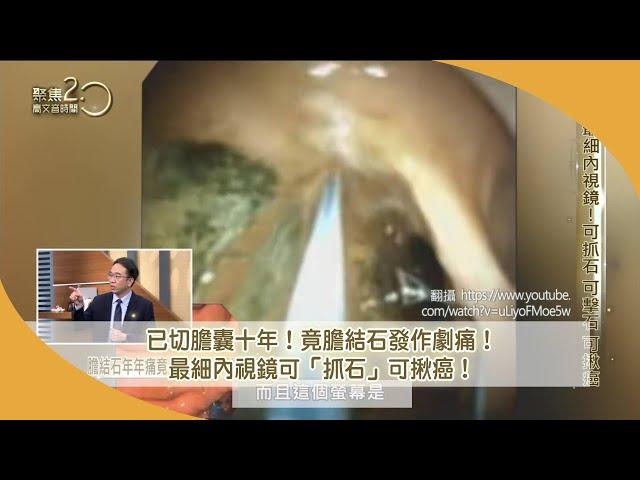 已切膽囊十年！竟膽結石發作劇痛 ！ 最細內視鏡可「抓石」可揪癌！【聚焦2.0】第478集