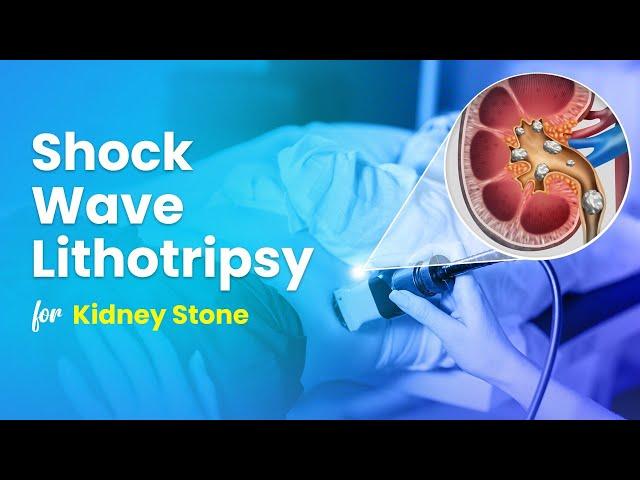 Shock Wave Lithotripsy (ESWL) for Kidney Stone Treatment - 3D Guide