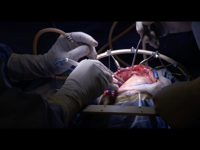 Brain Surgery (Craniotomy) | Inside the OR