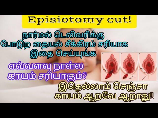 Normal delivery stitches fast recovery tips in tamil. தையல் பத்தின பயமே வேண்டாம்!இதை செய்யுங்க!