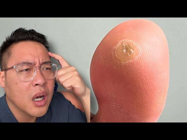 Is this a Callus or a Wart?