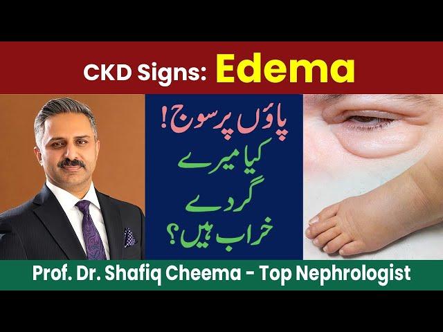 CKD Sign No 2 : Edema or Leg Swelling, Causes & Treatment