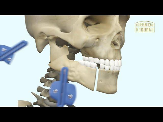 Реконструкция челюсти. Микрохирургия челюсти. 3D-анимация хода операции.